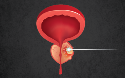 Fokální terapie